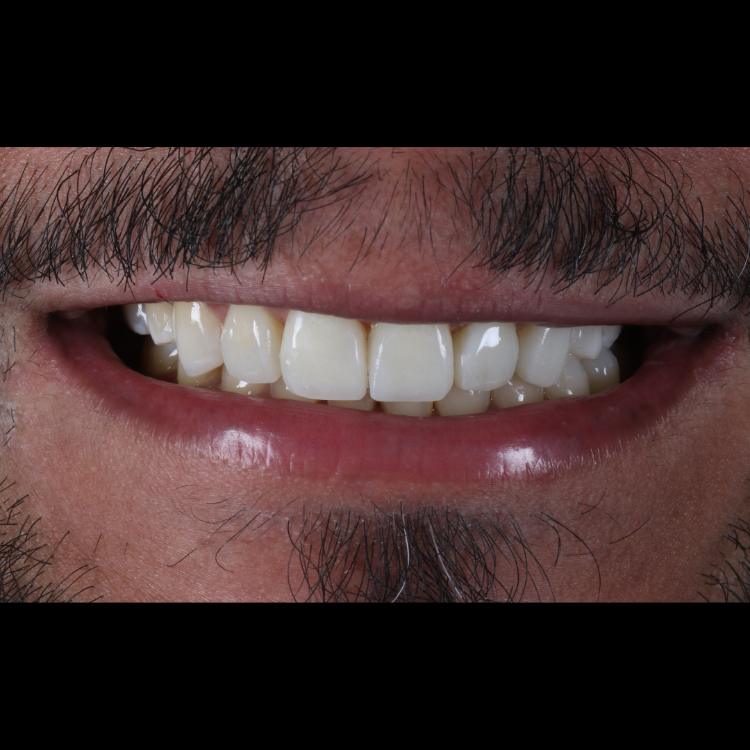 Depois — Facetas em Resina