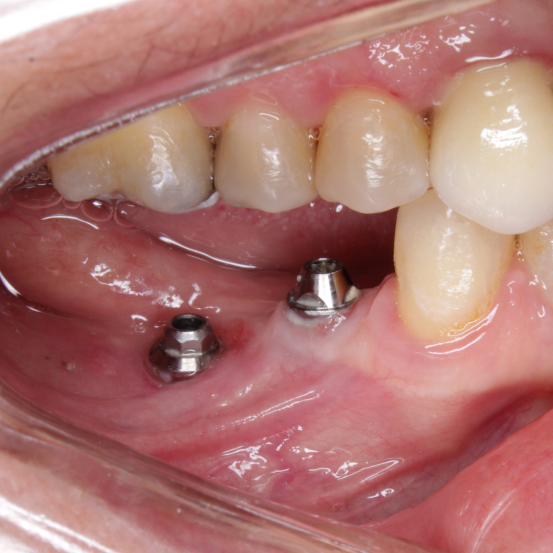 Antes — Implante Dentário