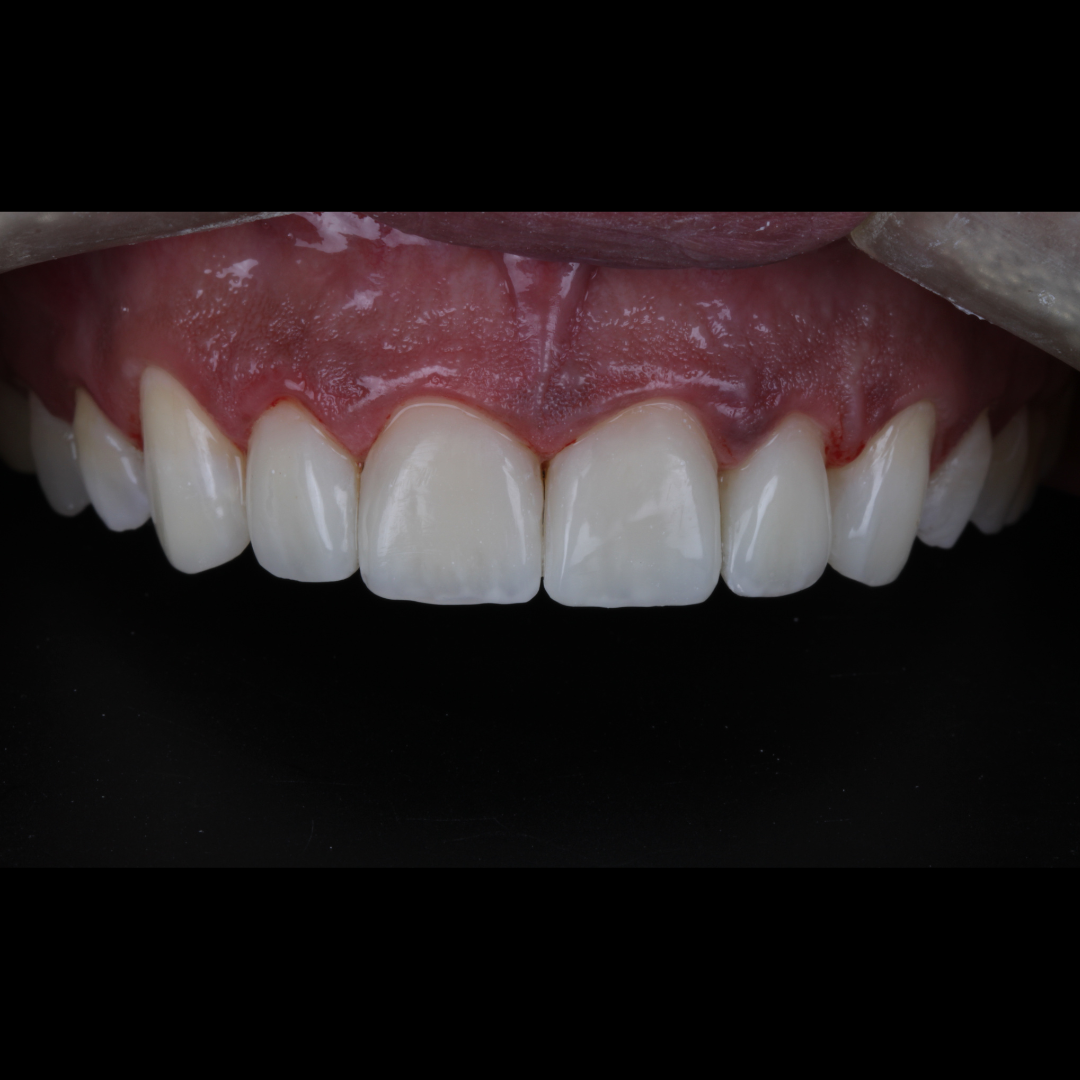 Depois — Facetas em Resina