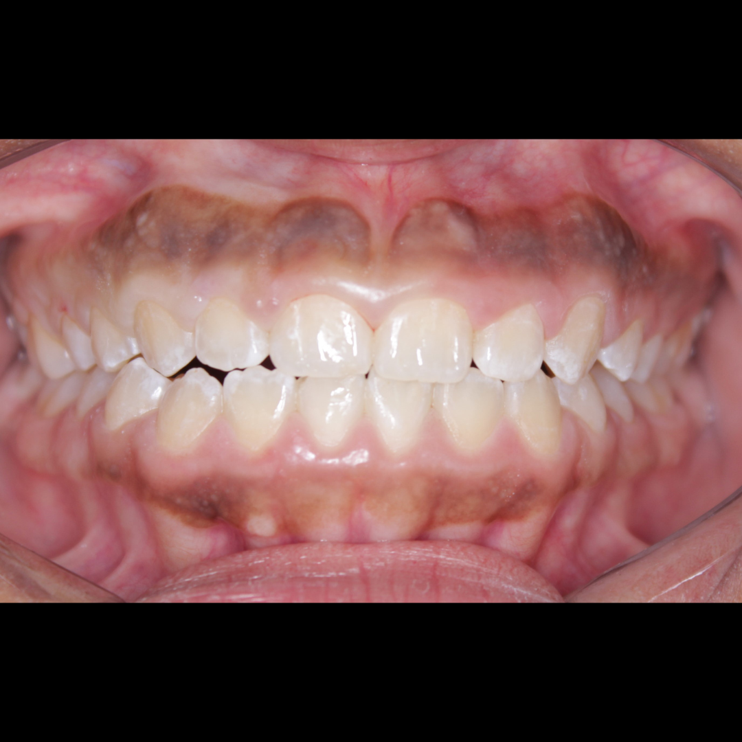 Antes — Gengivoplastia