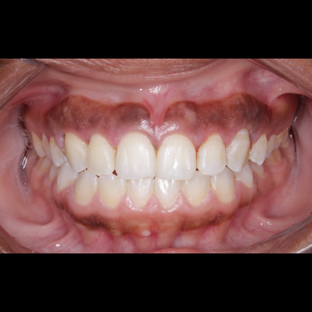Depois — Gengivoplastia