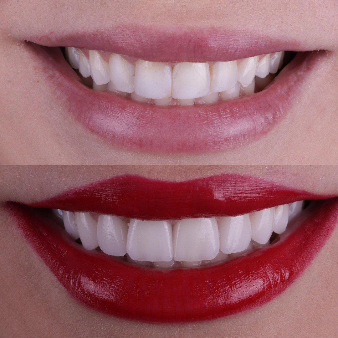 Estética dentária na Ideale Odontologia em Campinas