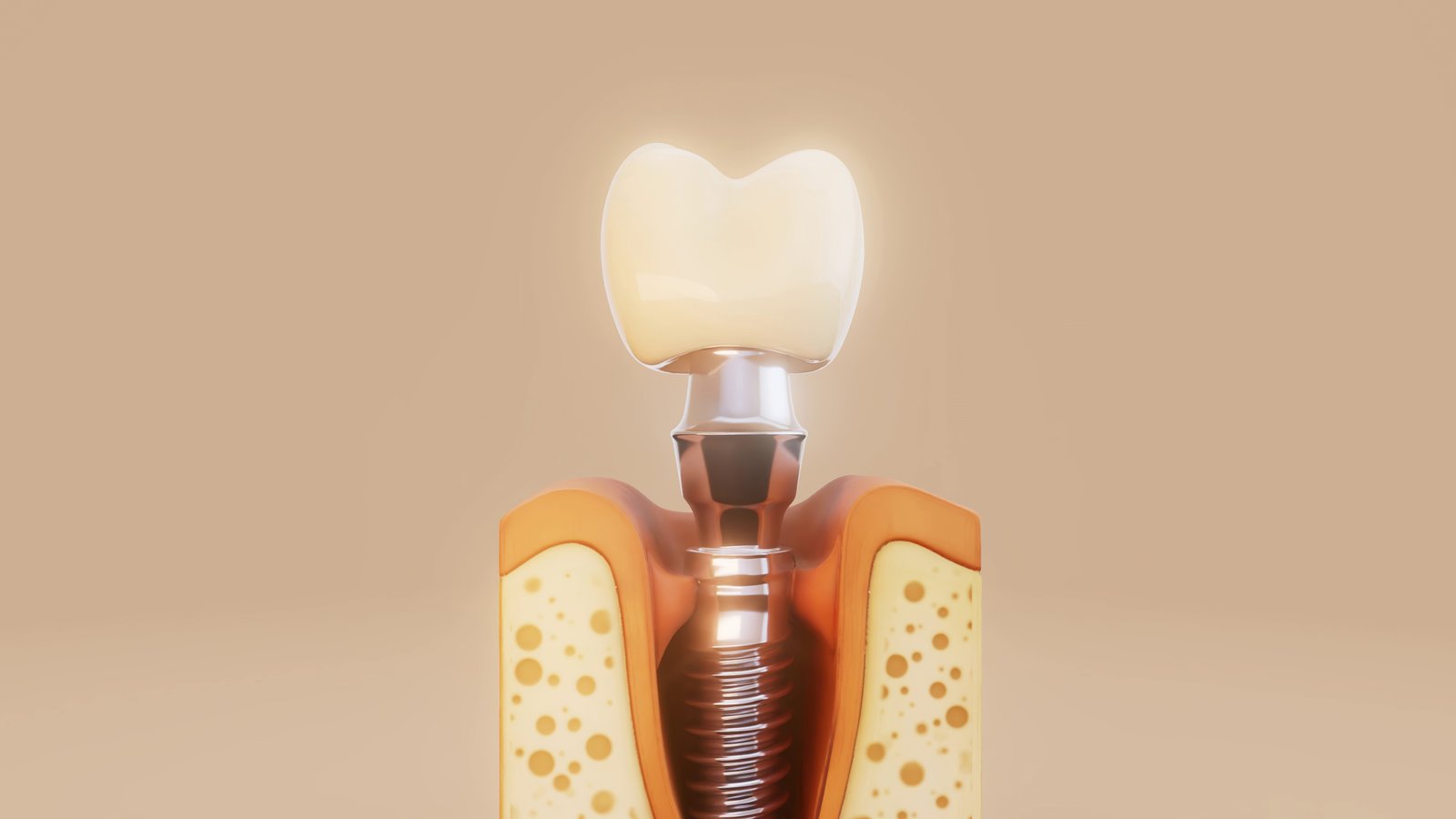 Implante dentário na Ideale Odontologia em Campinas